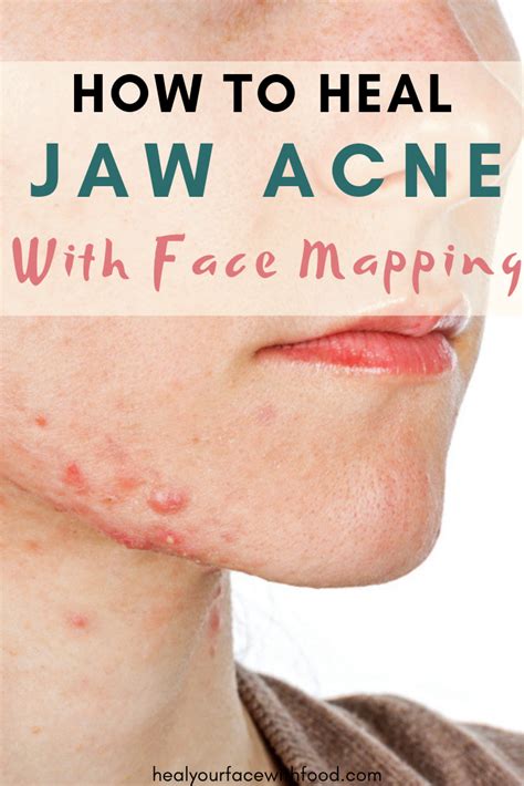 How To Get Rid Of Cystic Jawline Acne