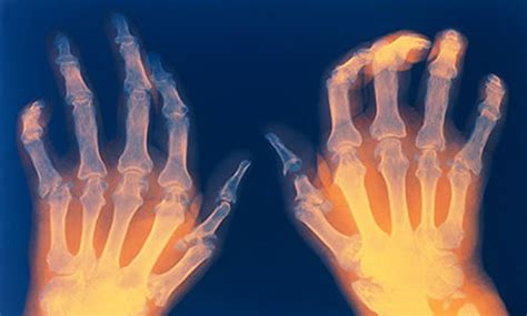 Rheumatoid Arthritis Treatment Options Symptoms Check