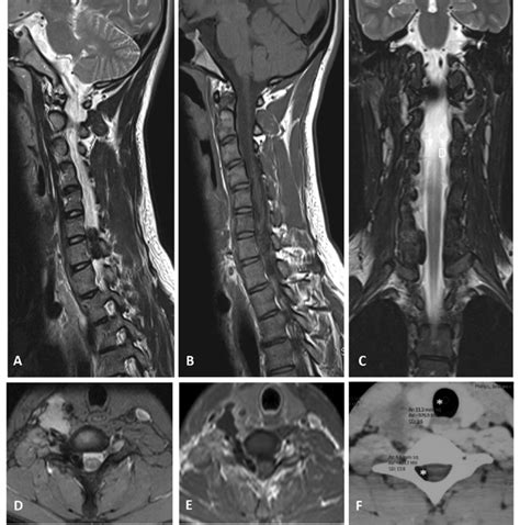 Mr And Ct Images Of The Cervical Spine Illustrating The Mass A