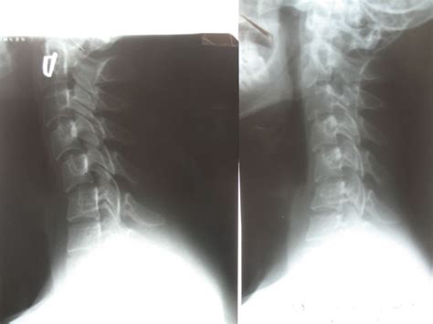 Kyphosis Of The Cervical Spine Symptoms Causes Treatment
