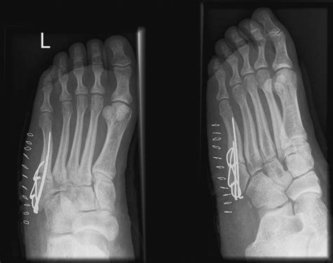 Fractures Of The Fifth Metatarsal Diagnosis And Treatment Injury