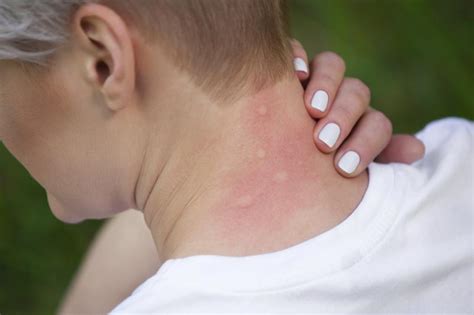 Common Rashes That Look Like Mosquito Bites Lovetoknow Health Wellness