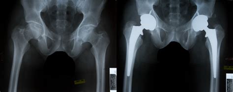 Should I Exercise Prior To Double Hip Replacement Joint Support