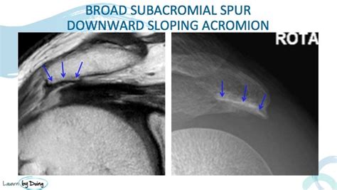 Mri Shoulder Sub Acromial Impingement Radedasia