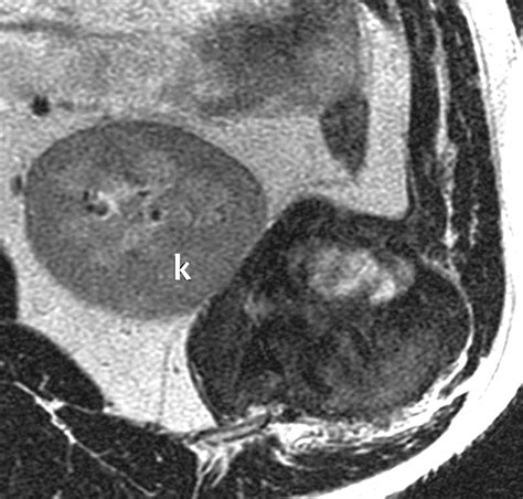 Imaging Of Primary Chest Wall Tumors With Radiologic Pathologic