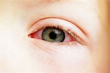 How Long Is Pink Eye Contagious? | YourCareEverywhere