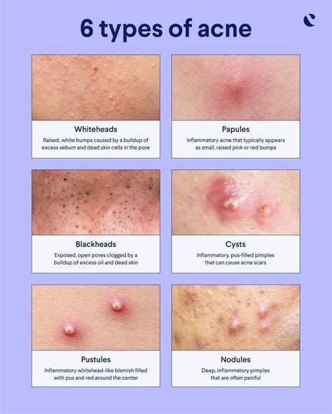 Types Of Acne Clogged Pores Whiteheads Blackheads Cysts Curology
