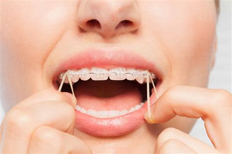 Importance of Elastics With Orthodontic Treatment - Maddux