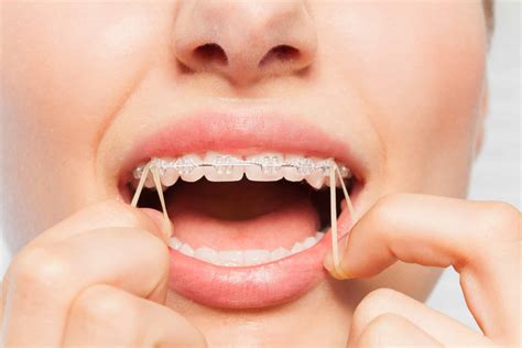 the importance of orthodontic elastics dunegan and cole orthodontics gainesville virginia