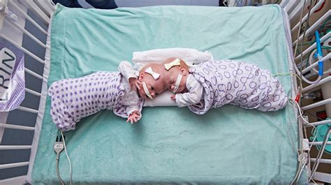 Doctors Just Separated Twin Girls Joined At The Head In One Of The World’s Rarest Surgeries