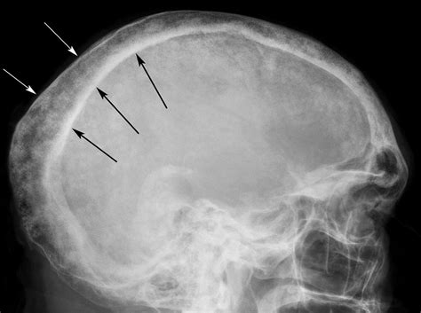 Plain Radiography Of The Skull After Investigation For Raised Calcium