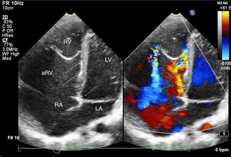 Tricuspid Annular Displacement Image In The Preoperative Download