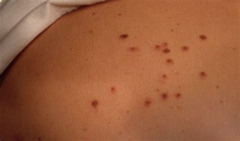 Cherry Angiomas Finesse Skin Clinic