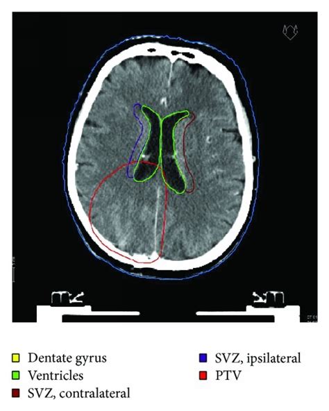 A Axial Planning Computed Tomography With Ventricles Subventricular