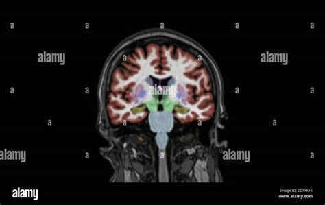 Magnetic Resonance Image Fotografías E Imágenes De Alta Resolución Alamy