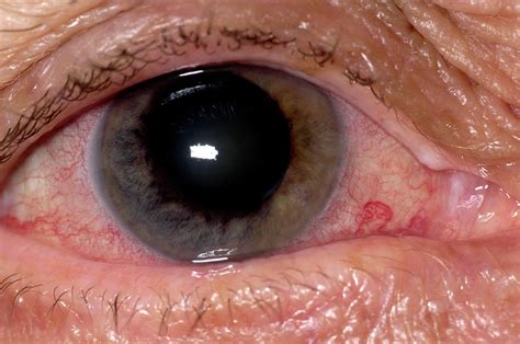Glaucoma is a group of eye diseases which result in damage to the optic nerve and cause vision loss. Acute Angle-closure Glaucoma Photograph by Dr P. Marazzi ...