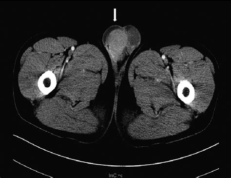 Figure 1 From Acute Promyelocytic Leukemia With Flt3 Tkd And Wt1