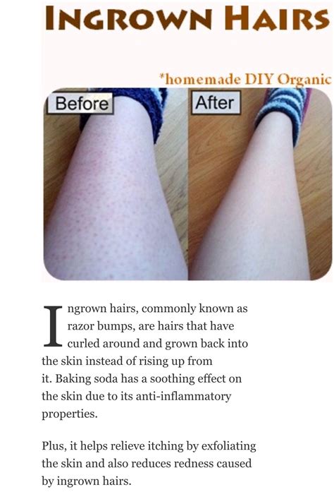 Ingrown Hair On Legs