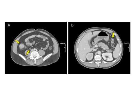 Colorectal Cancer Prevention Diagnosis And Therapeutic Options