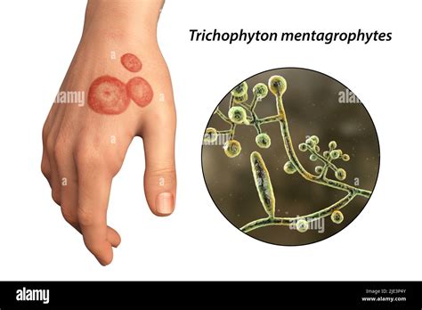 Fungal Infection On A Mans Hand Illustration Known As Ringworm