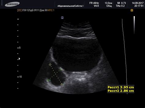 Diverticulum Of The Bladder With Images Ultrasound Ultrasound