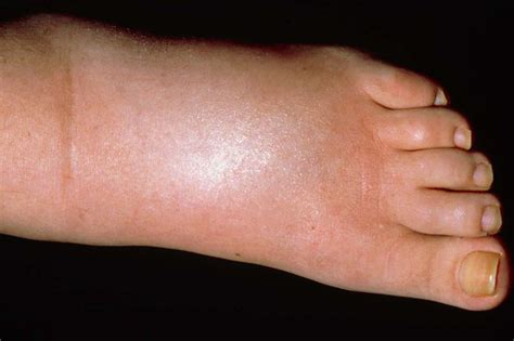 Bunions happen to the joint below your big toe on the inside of your foot. Foot pain - NHS.UK