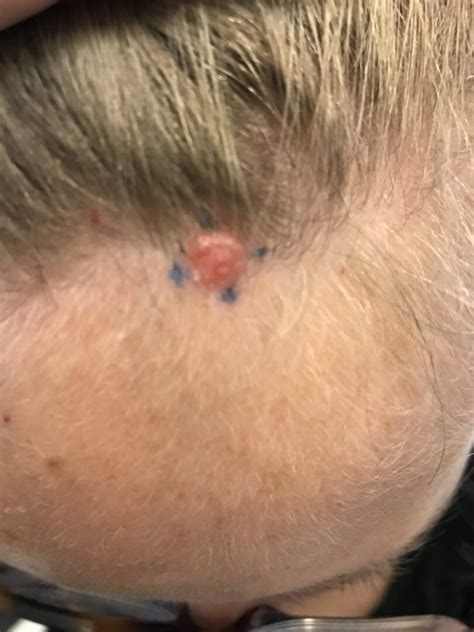 7 Facts You May Not Know About Basal Cell Carcinoma Ren Dermatology