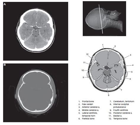 Head Ct Scan Procedure Radtechonduty Radiología Cuerpo Salud