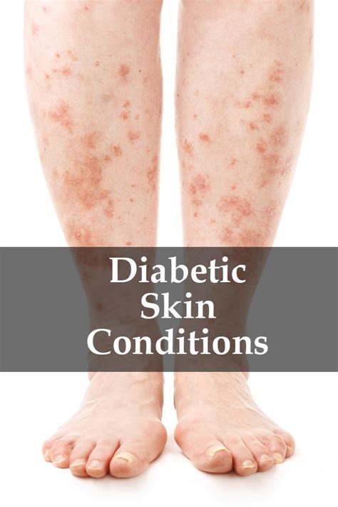 Diabetic Skin Problems A Vércukor Pontos Aránya