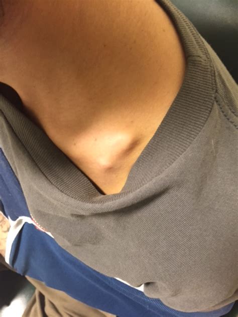 Wait You Want To Admit That Clavicular Fracture — Brown Emergency