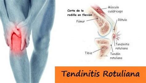 Qué es la Tendinitis Rotuliana