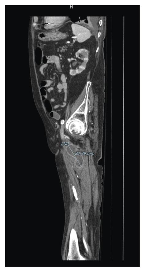 Ct Scan Sagittal Section Showing The Collection Still Present In The