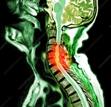 Compressed Spinal Cord Mri Scan Stock Image C0217937 Science