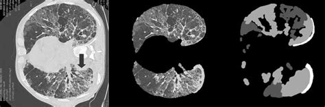 Dataset Sample Ct Scan Left Masked Lungs Middle And Labeled