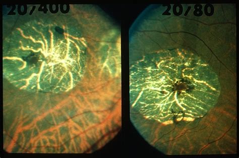 Macular Atrophy With Staphyloma Fa Retina Image Bank