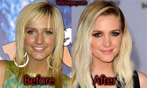 Ashlee Simpson Plastic Surgery Before And After Nose Job Pictures