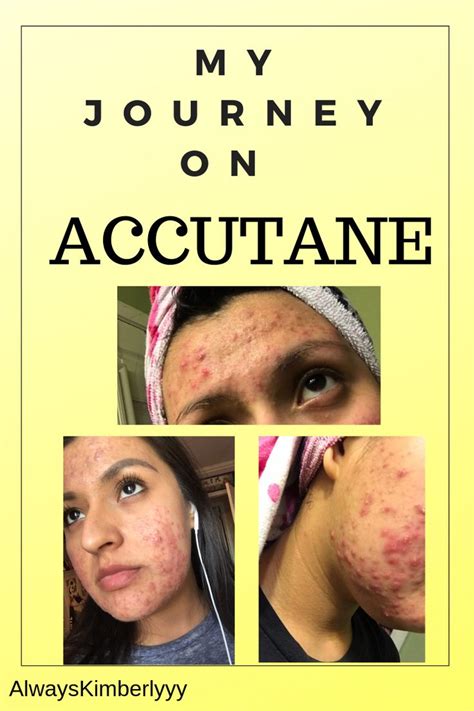 My Journey On Accutane Accutane Severe Acne Treatment Itchy Scalp