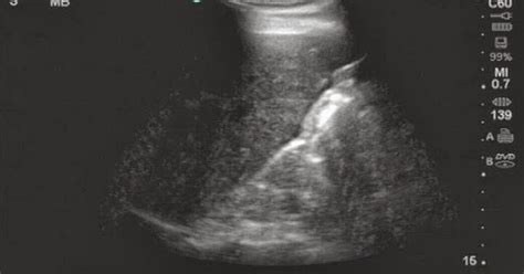 Vietnamese Medic Ultrasound Case 210 Left Abdominal Mass Dr Phan