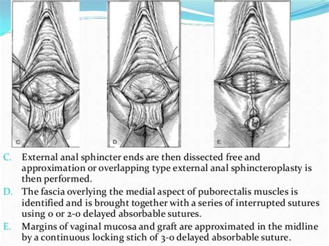 Perineal Lacerations