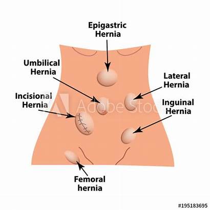 Hernia Inguinal Types Hernie Umbilical Incisional Intestinale