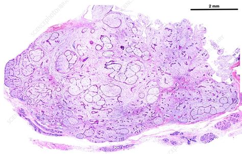 Breast Fibroadenoma Light Micrograph Stock Image C0426505