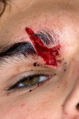 Facial Laceration - Stock Image - C012/3763 - Science Photo Library