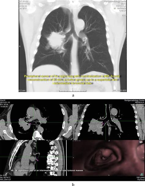 Virtual Bronchoscopy For Tumors And Traumatic Lesions Of The Airways