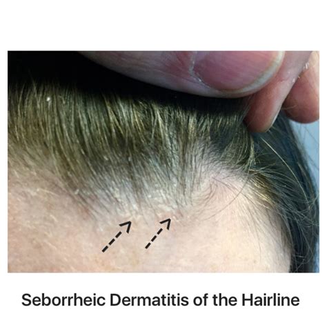 Some people suffering from seborrheic hair loss even avoid seeing their friends and. Can drugs cause or exacerbate seborrheic dermatitis ...