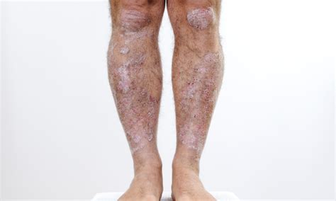 9 Best Ways To Speed Healing Of Psoriasis On Legs Nuvothera™