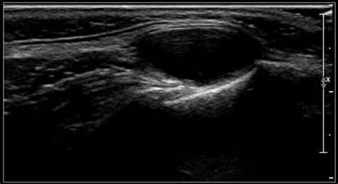 Subcutaneous Dermoid Cyst Ultrasound