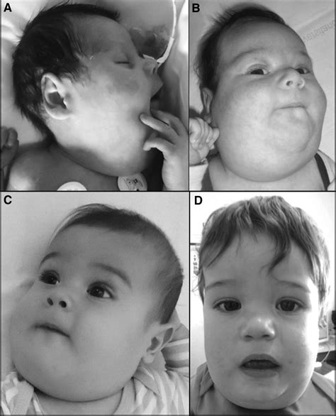 Oral Sirolimus An Option In The Management Of Neonates With Life