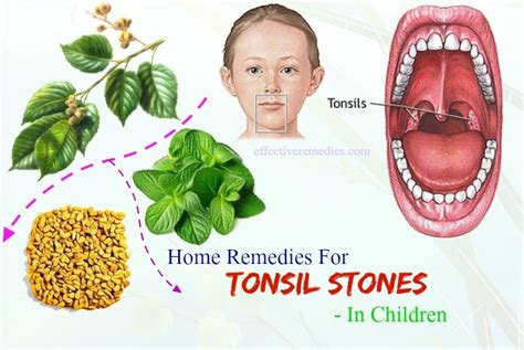Surgery For Tonsil Stones Causes Symptoms Removal And Treatment