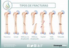 Fracturas óseas, tipos, cuidados y tratamiento | FisioOnline