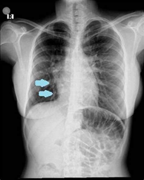 Figure 1 Chest X Ray Enlarged Pulmonary Hilum Increased Area Of The